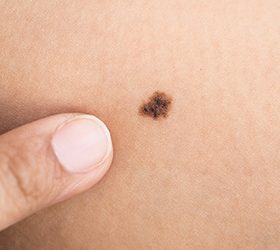 Lunares y manchas en la piel