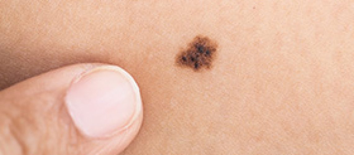 Lunares y manchas en la piel